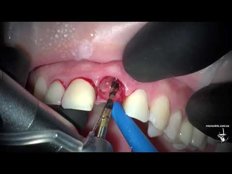 Как удаляют и имплантируют зубы в один визит.