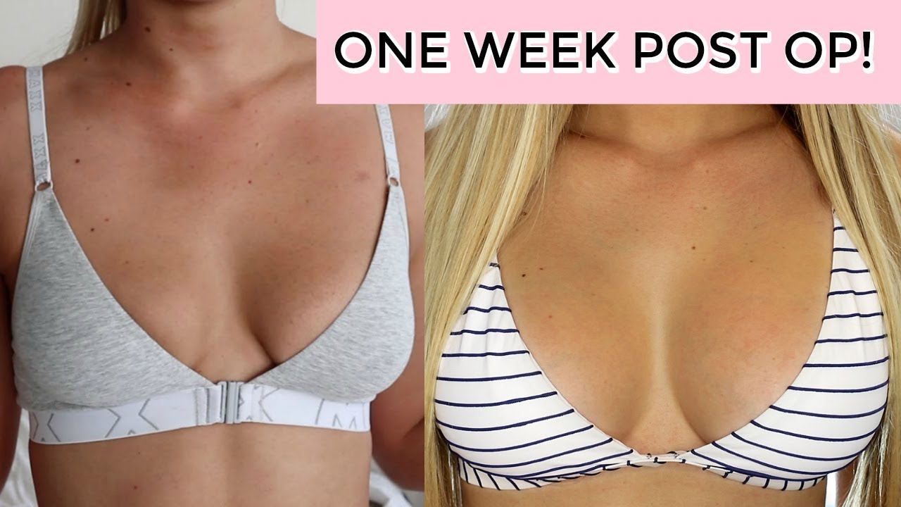 Week After Breast Augmentation 25