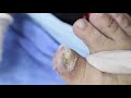 Ep_2067 Ingrown toenail removal 👣 ตรงนี้ล่ะ..ตื่นเต้น 😷 (This clip is from Thailand)