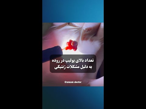 پولیپ های متعدد روده