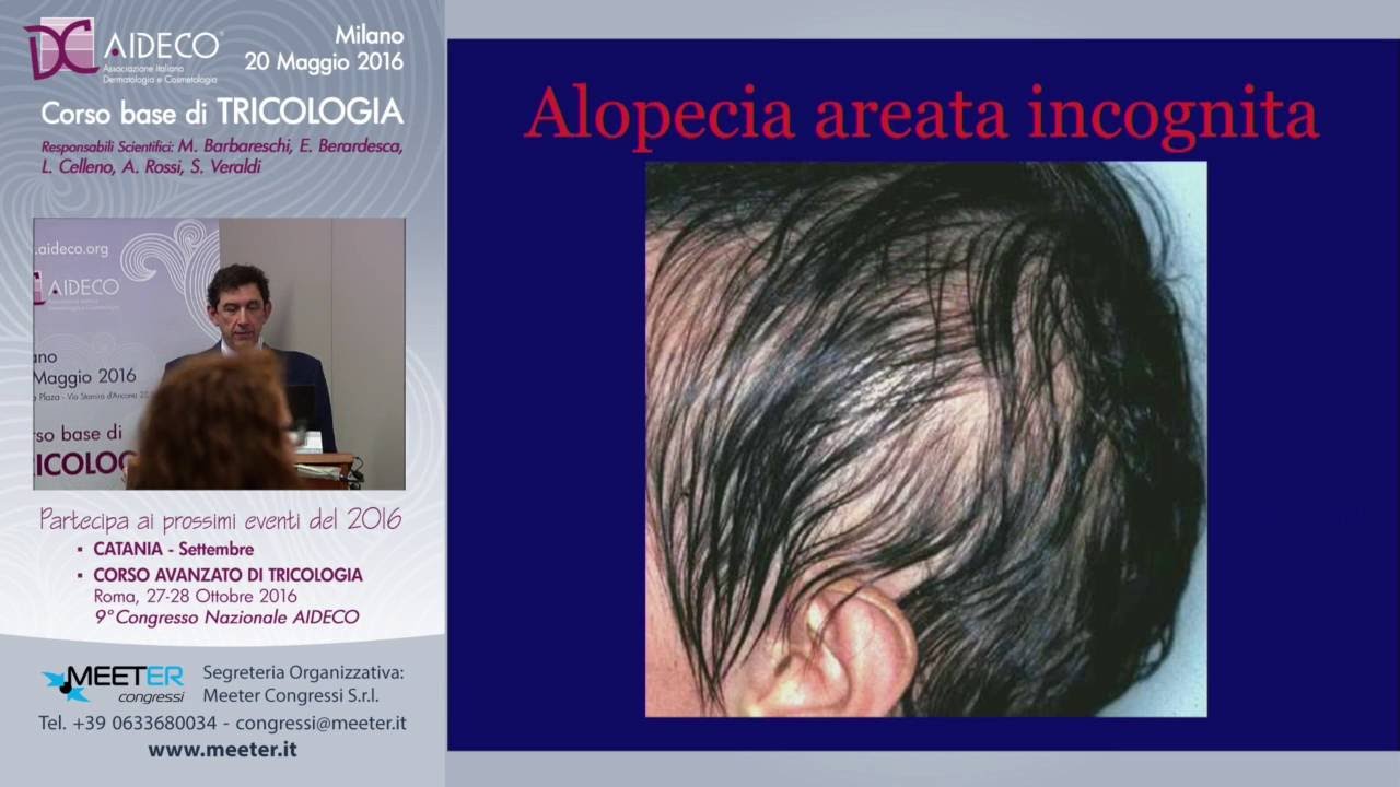 M. Barbareschi - Le alopecie: una overview e Come allestire un ambulatorio di tricologia