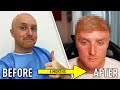 My 6 Month Hair Transplant Results! BEFORE & AFTER