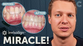 Impossible Smile Transformation Solved with Invisalign  Full Case Study