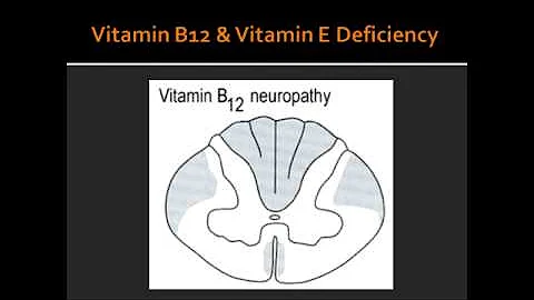 Spial Cord Lesion - Syringomyelia, Vitamin B12 Deficiency & Vitamin E Dificiency
