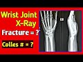 How to read wrist joint Fracture X-Ray | Colles Fracture | Fracture Distal Radius | Uday Xray