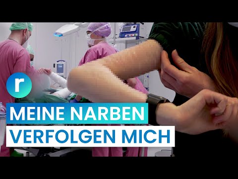 Video: 10 Möglichkeiten, selbstverletzende Narben zu verbergen