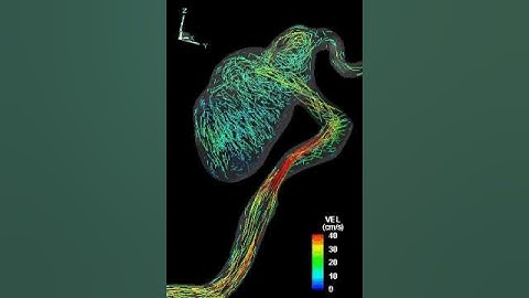 Pulsatile flow in a giant aneurysm I