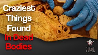 5 Craziest Things I've Found In Dead Bodies screenshot 2