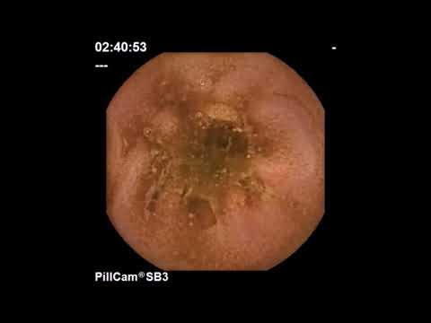 Endoscopic Obliteration of Gastric Varices. 