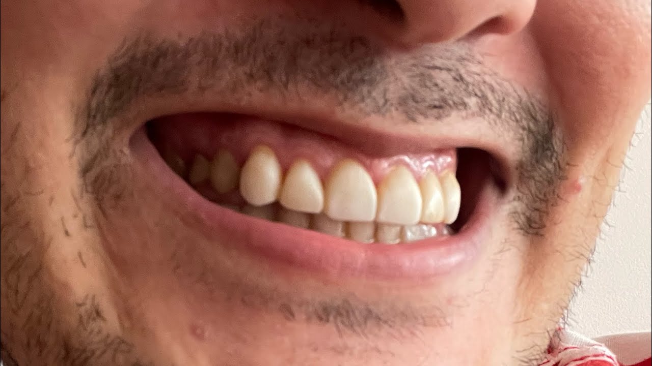 Facetas de resina DEPOIS QUE DEU ERRADO ficou assim meus dentes.
