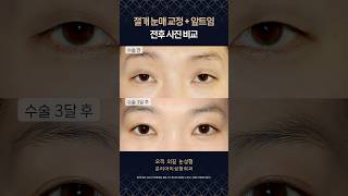 절개 눈매 교정 앞트임 전후 비교💖 #절개눈매교정