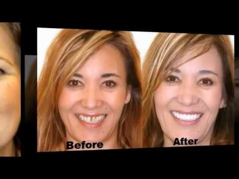 dental-implants-before-and-after1-kansas-call-free-877-292-6308