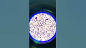 thalassemia peripheral blood smears with hypochromic, microcytic red blood cells and poikilocytosis