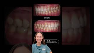 Как мы убрали боль в челюсти и выровняли зубы с Invisalign #здоровьезубов #лечениеприкуса