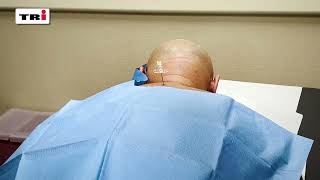 Cervical Spine Epidural Steroid Injection