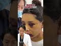 【美容整形】これって失敗?衝撃のダウンタイム!! #shorts