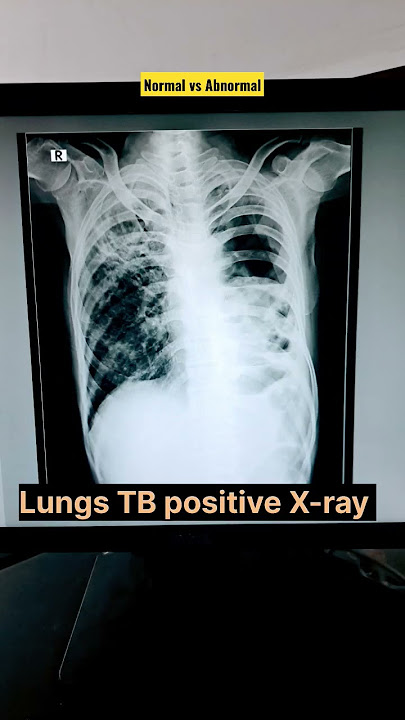 Chest X-ray Normal vs Abnormal  #shorts