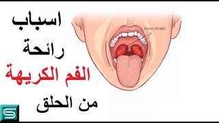 رائحة الفم الكريهة من الحلق  || أسباب وراء رائحة الفم الكريهة