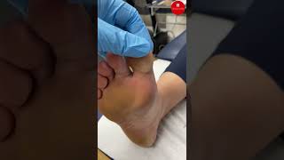 Inside Of The First Toe Callus