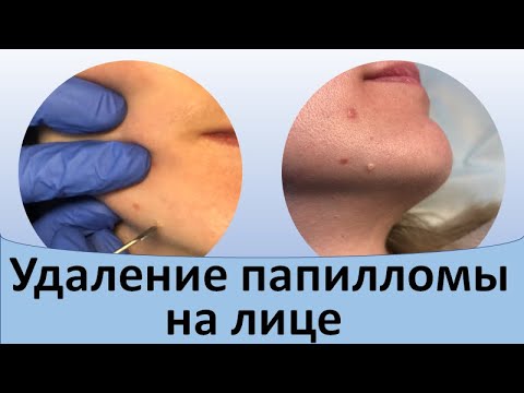 Удаление папилломы на лице