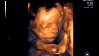 20141216 Terezka - V bříšku, 3D ultrasound (20tt)