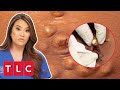 Woman Has Over 500 “PEBBLE” Bumps All Over Her Body | Dr Pimple Popper: This Is Zit