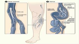 Cuales Son Los Sintomas De Varices Internas En Las Piernas 2(http://varicesnuncamasporsiempre.blogspot.com.ar/ varices nunca mas funciona remedio para las varices remedios para las varices remedio para varices ..., 2014-07-26T22:46:30.000Z)