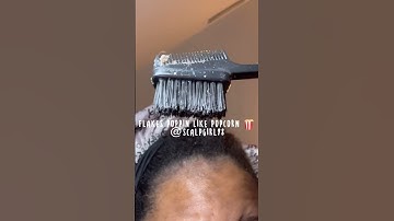 3D Flakes #bigflakes #seborrheicdermatitis #dirtyscalp #dandruff #psoriasis #lupus #viral #trending