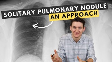 My approach to solitary pulmonary nodules