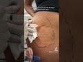 NON SURGICAL BRAZILLIAN BUTT LIFT