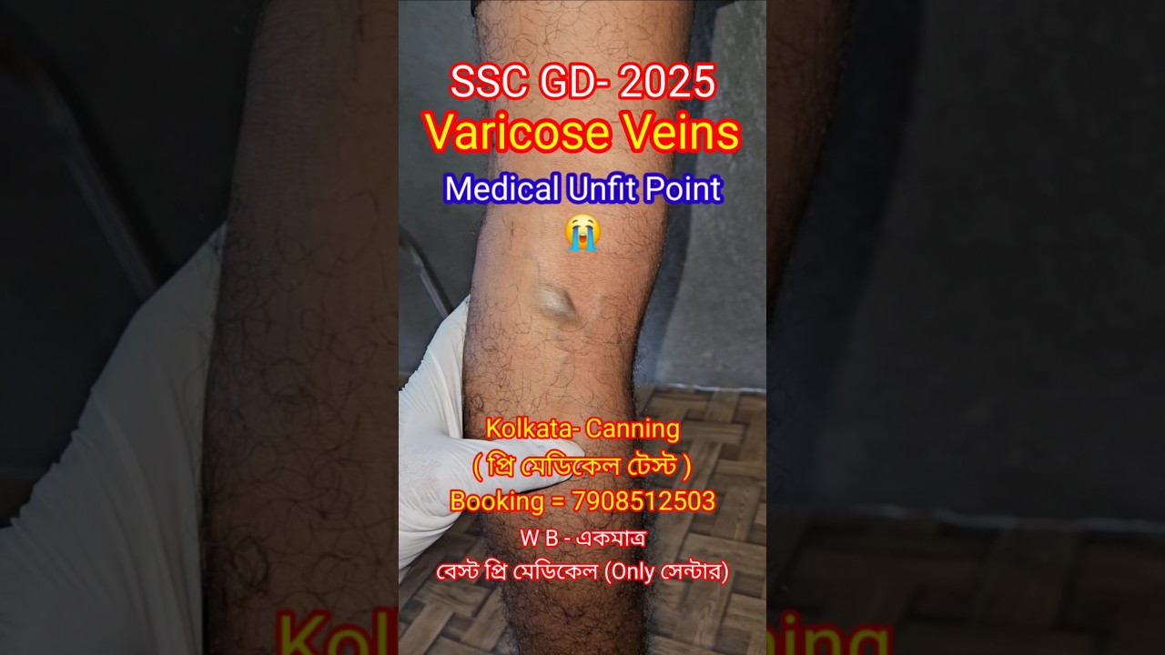 SSC GD- Varicose Veins Unfit Point 