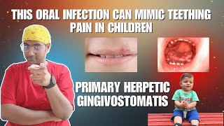 Dr Rudra Mohan | Primary Herpetic Gingivostomatitis| Herpes Simplex Virus Infection in Children