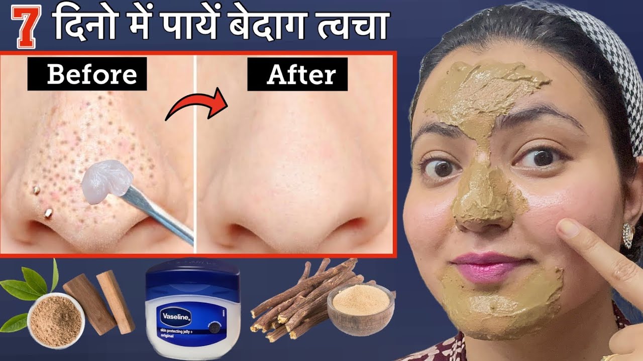 कितने भी जिद्दी Blackhead Whitehead कील सफेद दाने,Clogged Pores, Scars हों, इस Remedy से होगा कमाल💕
