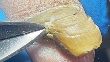 Thick, Infected Nails, Too Much Fungal Infection, Trimmed Quickly【Pedicure Master Lin Jun】