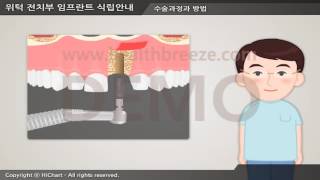 [Demo] c0151aako Guide to Maxillary Anterior Implant Placement: Stage 1 Surgery