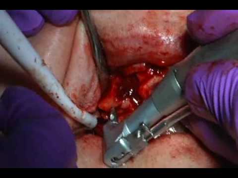 Dental Implant Surgery Video (part 1)