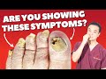 4 SYMPTOMS OF FOOT FUNGUS! | Holistic Toenail Fungus Cures Part 1 | Dr. Kim, Holistic Foot Doctor