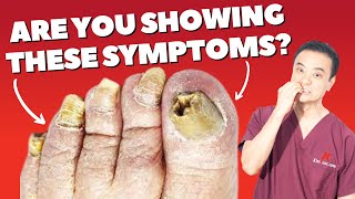 HOW To Detect TOENAIL FUNGUS | Holistic Toenail Fungus Cures Part 1 | Dr. Kim, Holistic Foot Doctor