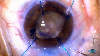 Be ready! From Phaco to Intracapsular Cataract Extraction: dense phacodonesis cataract surgery