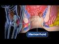 Hemorrhoid removal  step by step