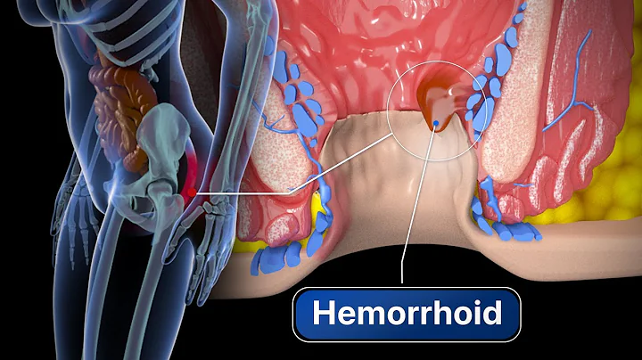 Hemorrhoid Removal | Step by step - DayDayNews