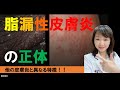 脂漏性皮膚炎の「正体」とは⁈～他の皮膚炎と異なる大きな特徴はコレです！！コレを抑制すると改善する！！