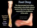 Foot Drop, Peroneal Nerve Injury - Everything You Need To Know - Dr. Nabil Ebraheim
