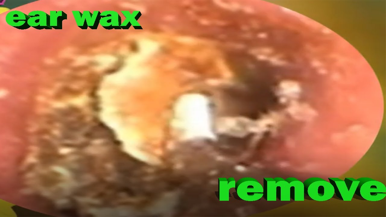 THE BIGGEST PIECE OF EAR WAX REMOVED...EVER! .ear wax removal EP215 YouTube