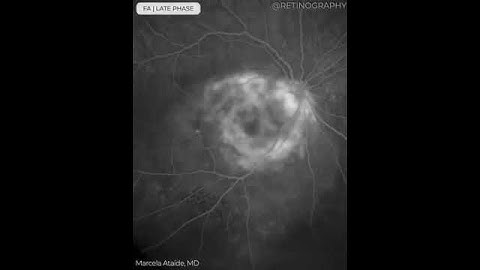 CHOROIDAL MELANOMA MULTIMODAL ANALYSIS For more images like this visit www.retinography.org #retina