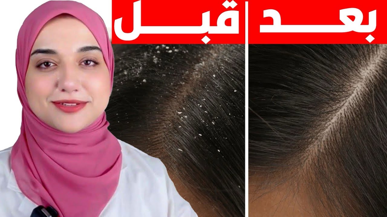 التخلص من القشرة المتكتلة و الكثيفة في فروة الراس و الحكة /تنظيف فروة الراس