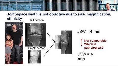 Artificial Intelligence in Knee Osteoarthritis Diagnostic