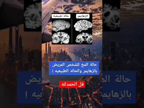 حالة المخ للشخص المريض بالزهايمر