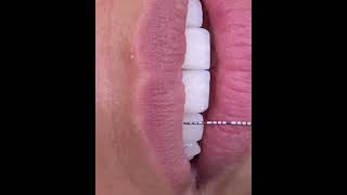 Checking Incisal Display At Rest During Functional Prototype Try In.