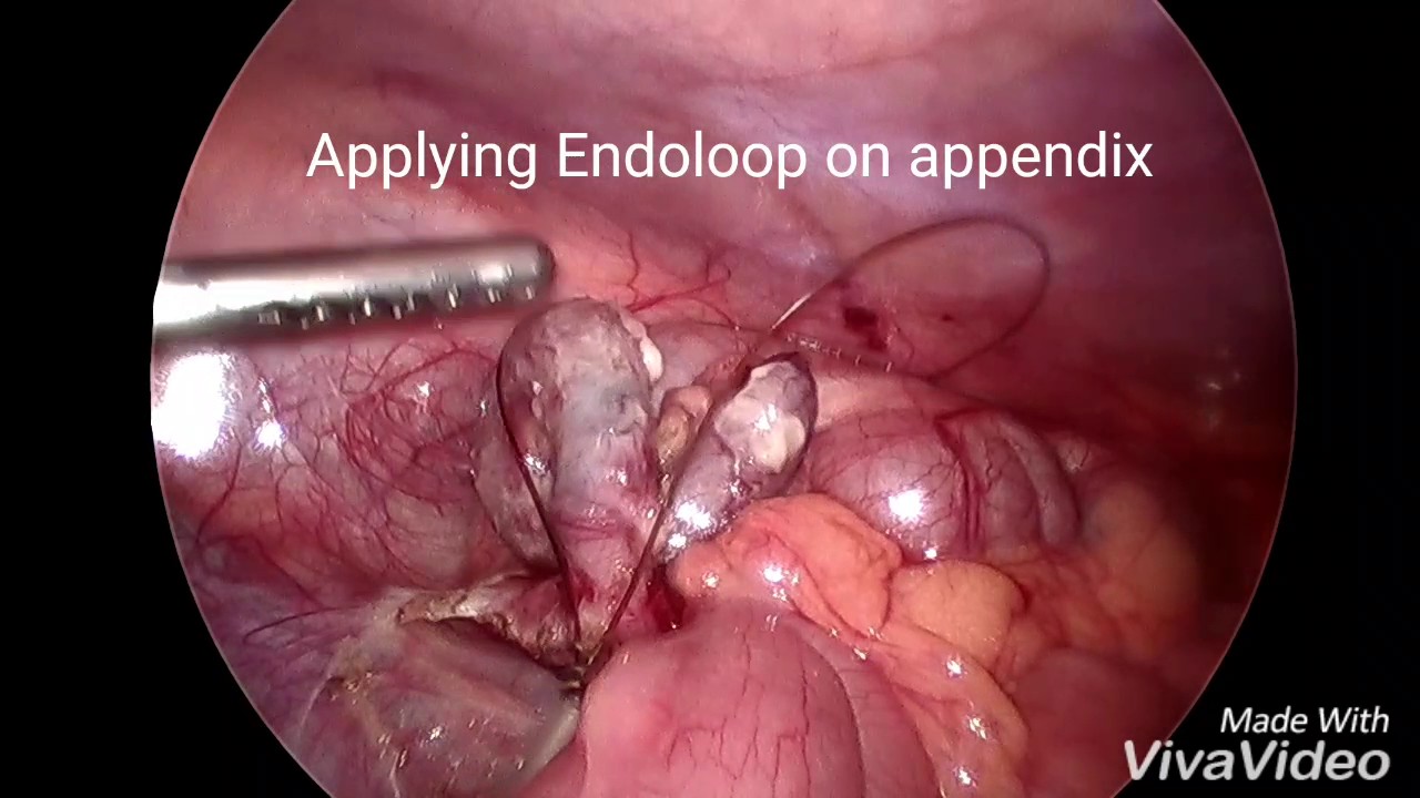 latest treatment surgery for acute appendicitis laparoscopic